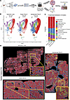 Single-cell spatial transcriptomic atlas of human FALD with early and advan