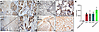 Immunohistochemistry showed expression of TRANCE in pediatric chronic pancr