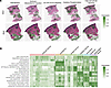 Spatial transcriptomic analyses reveal enrichment of PI3K pathway in distin
