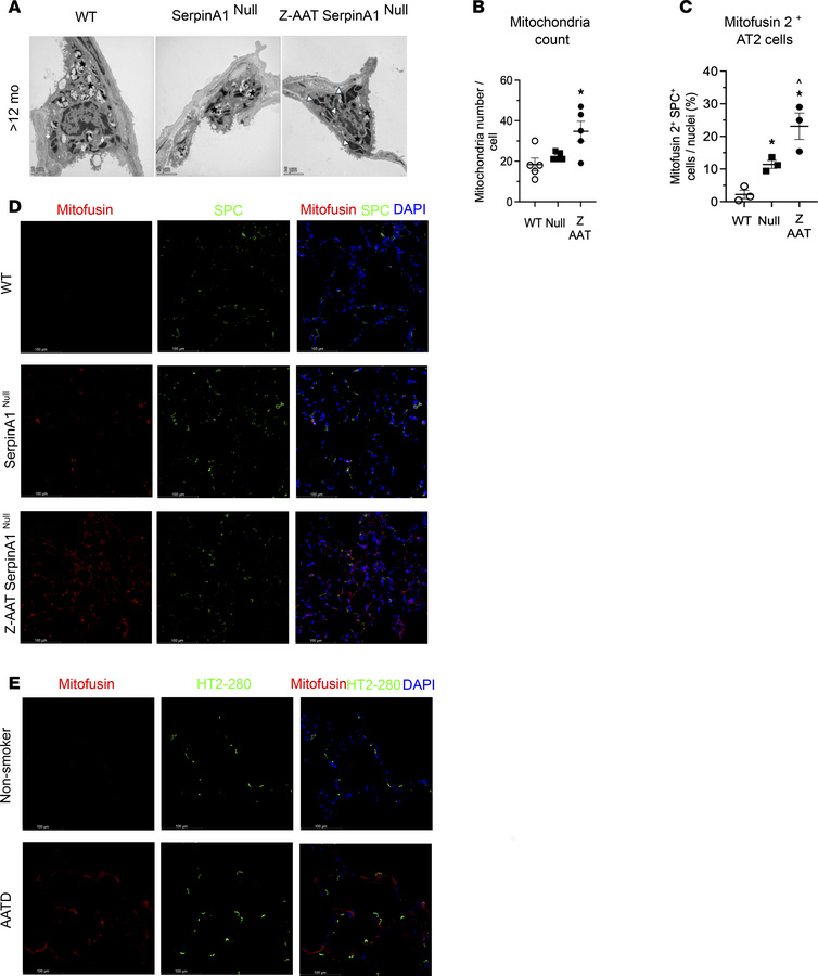Z-AAT polymers accumulation in alveolar type-2 epithelial cells is assoc...