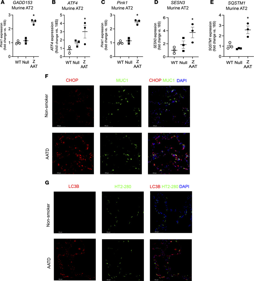 Z-AAT polymers accumulation in alveolar type-2 epithelial cells is assoc...