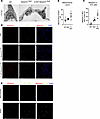Z-AAT polymers accumulation in alveolar type-2 epithelial cells is associat