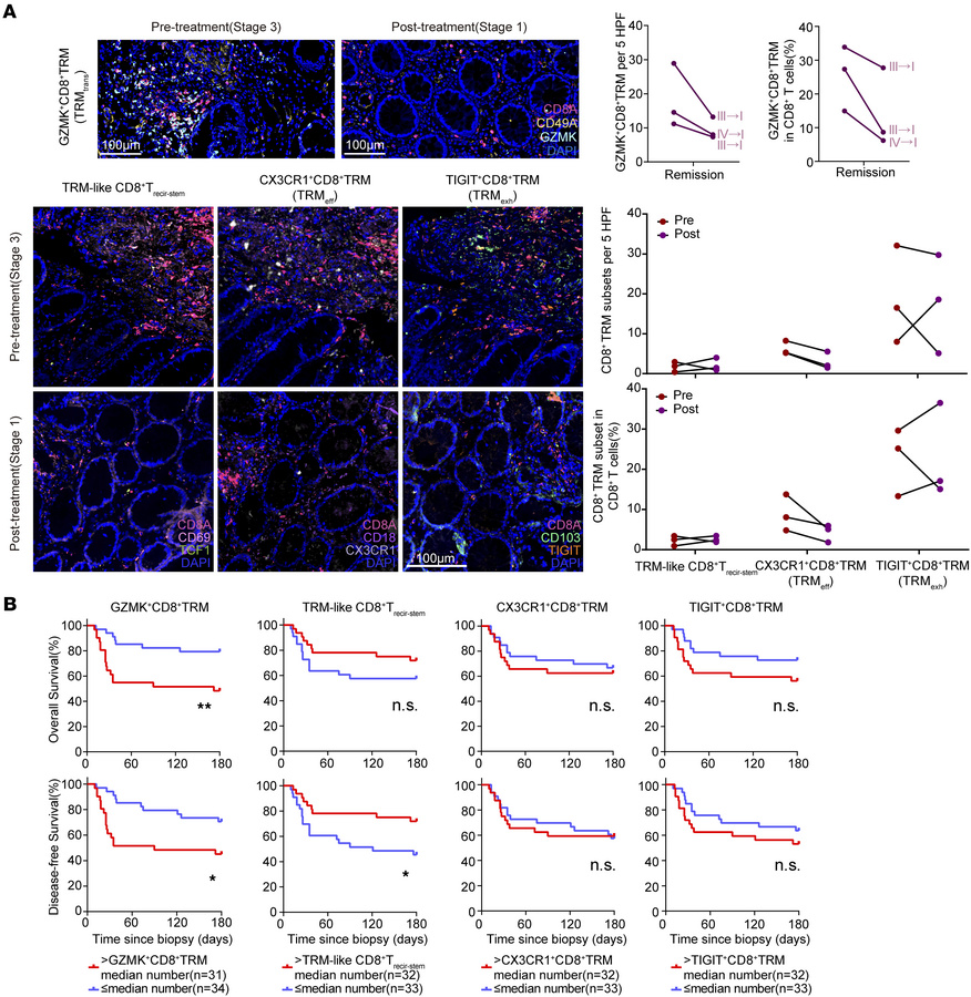 GZMK+CD8+ TRM cell infiltration decreases after remission and predicts p...