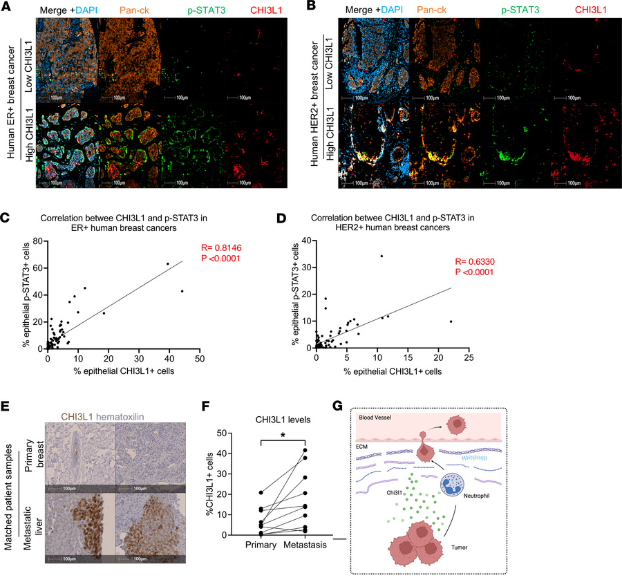 CHI3L1 correlates with STAT3 and is enriched in metastatic patient tumor...
