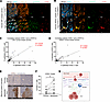 CHI3L1 correlates with STAT3 and is enriched in metastatic patient tumors.