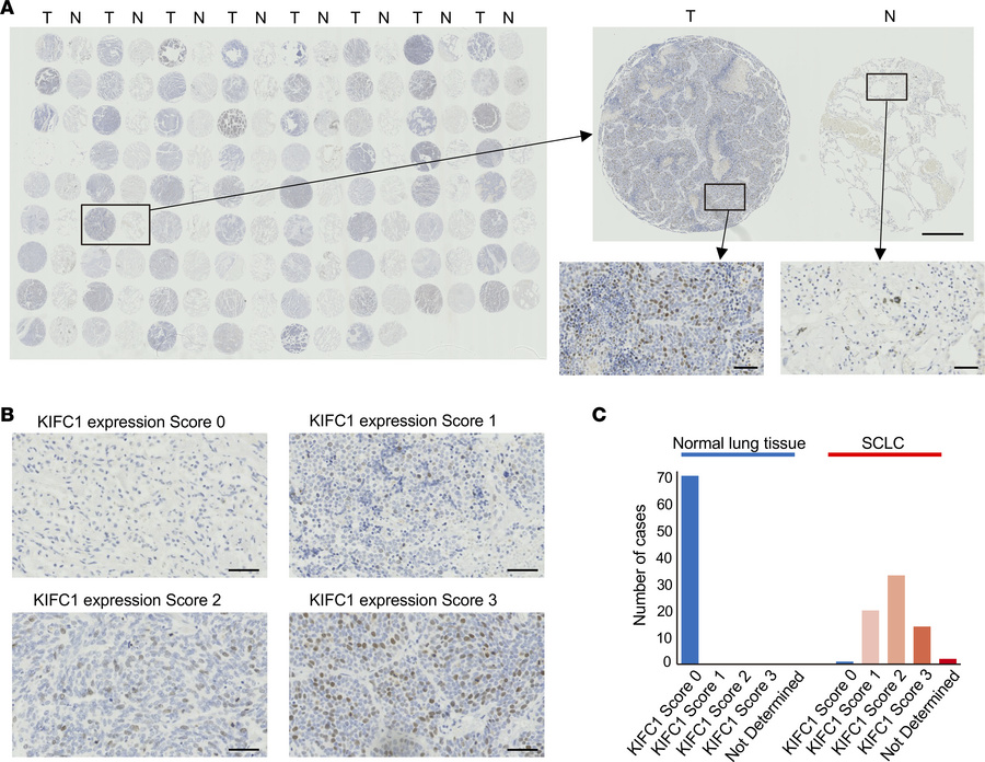 IHC analysis of KIFC1 protein expression in paired SCLC and adjacent nor...