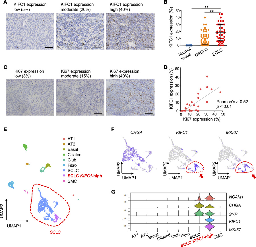 IHC analysis of KIFC1 protein expression in SCLC clinical samples using ...