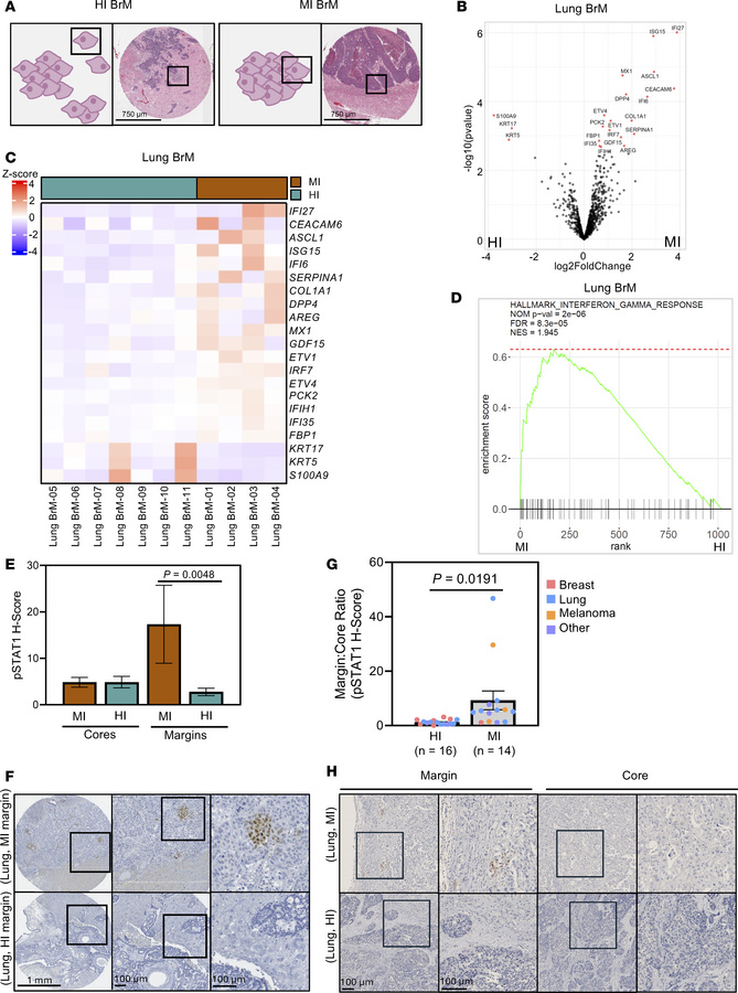 NanoString Digital Spatial Profiling reveals augmented interferon-γ sign...