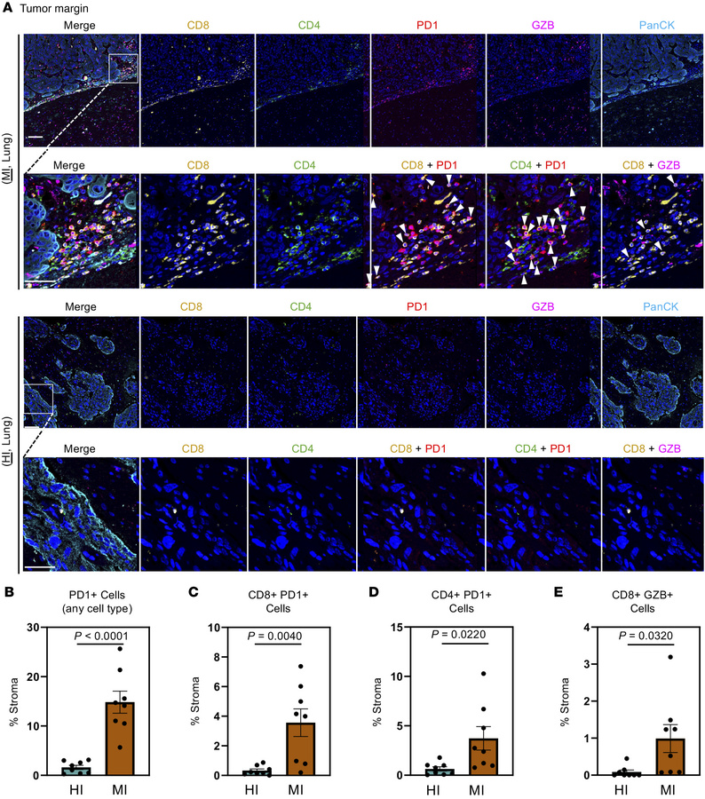 MI BrMs are characterized by granzyme B+ and PD-1+ T cells.
(A) Represen...