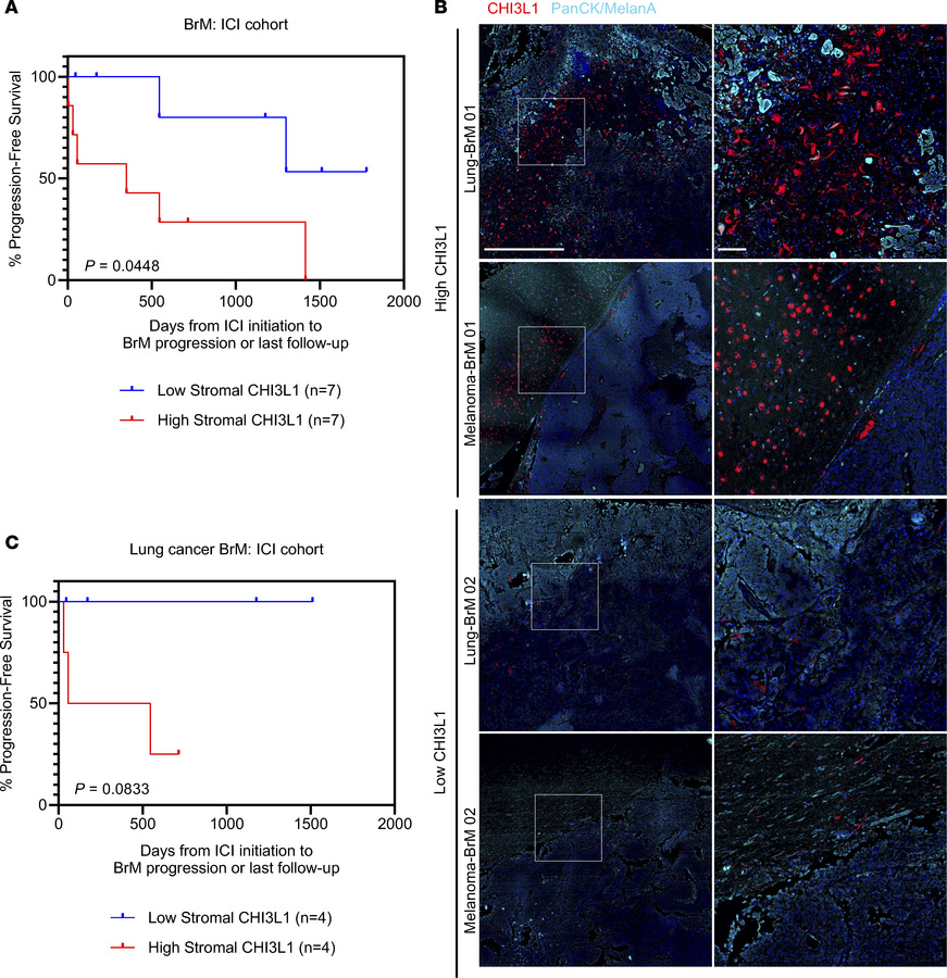 Low CHI3L1 expression in patient BrMs is associated with improved respon...