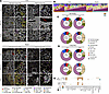 MI BrMs are characterized by a greater degree of immune infiltration when c