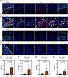 MI BrMs are characterized by granzyme B+ and PD-1+ T cells.