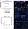 Low CHI3L1 expression in patient BrMs is associated with improved response