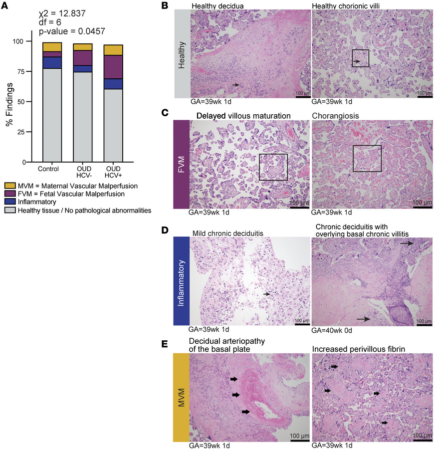 Maternal OUD±HCV is associated with inflammation and fetal/maternal vasc...