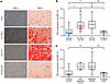 TNF-α expression in renal tubular compartments during immune checkpoint inh