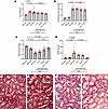 Conditional proximal tubule FATP2 deletion ameliorates HFD + STZ–induced DK