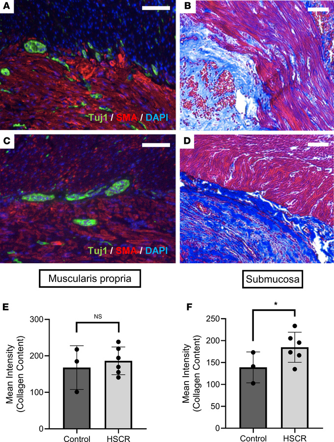 Patients with HSCR have increased fibrosis in ganglionic intestine.
(A a...