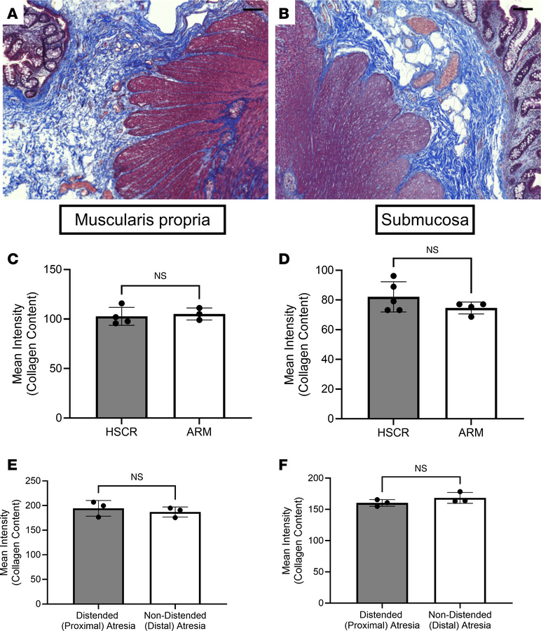 No difference in fibrosis in age-matched HSCR, ARM, and patients with in...