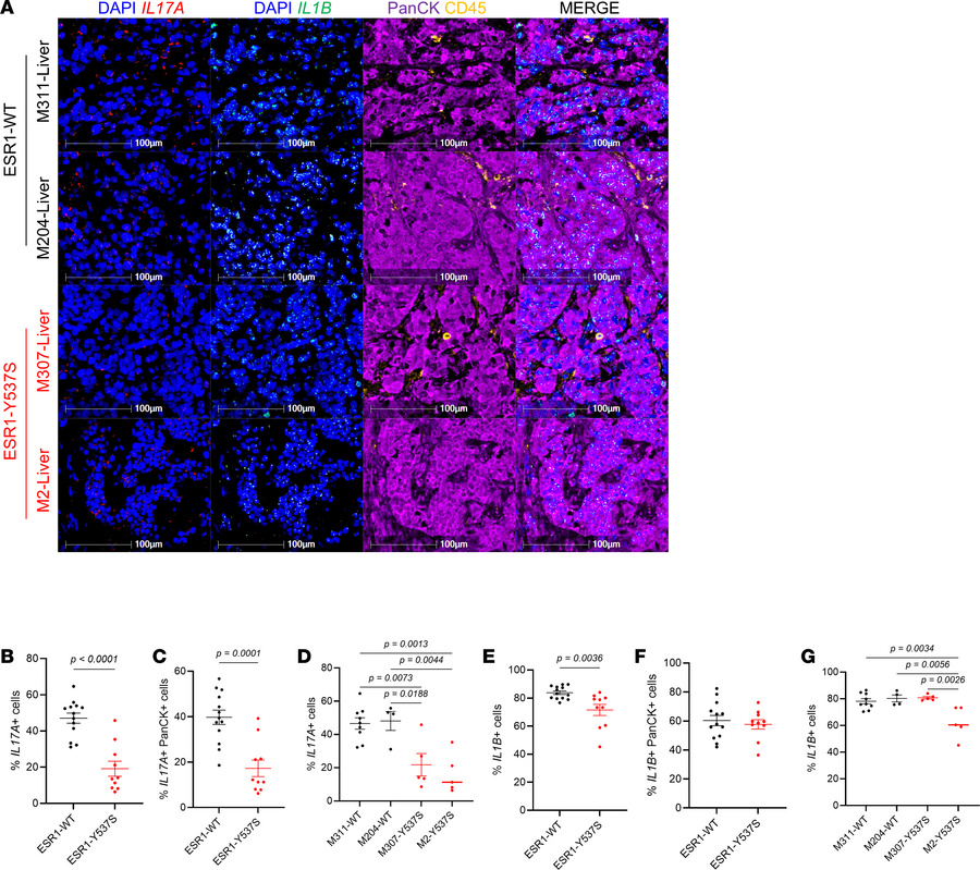 
IL17A and IL1B are decreased in ESR1Y537S metastatic tumors from patien...