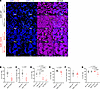 IL17A and IL1B are decreased in ESR1Y537S metastatic tumors from patients w