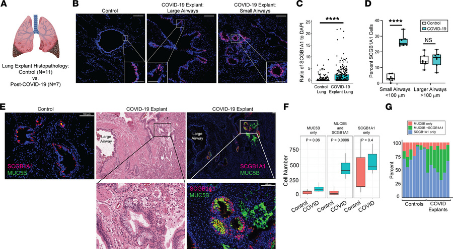 Increased SCGB1A1 immunofluorescence with MUC5B in small airways of the ...