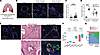 Increased SCGB1A1 immunofluorescence with MUC5B in small airways of the lun