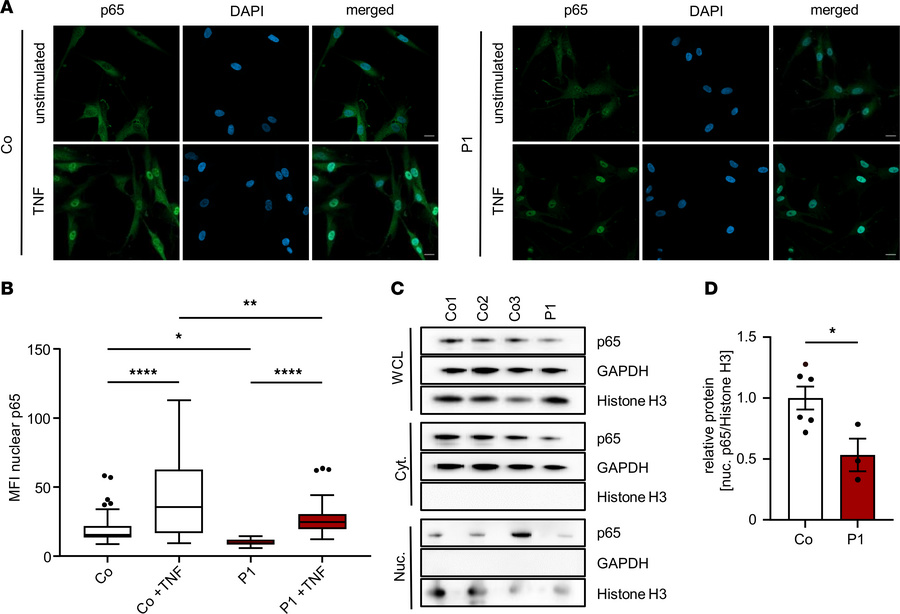 Altered nuclear translocation of p65 in patient fibroblasts.
(A) Represe...