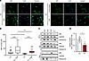 Altered nuclear translocation of p65 in patient fibroblasts.