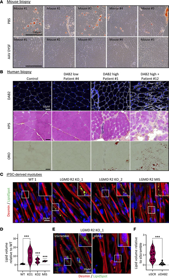 DAB2 expression is associated with lipid accumulation in dysferlin-defic...