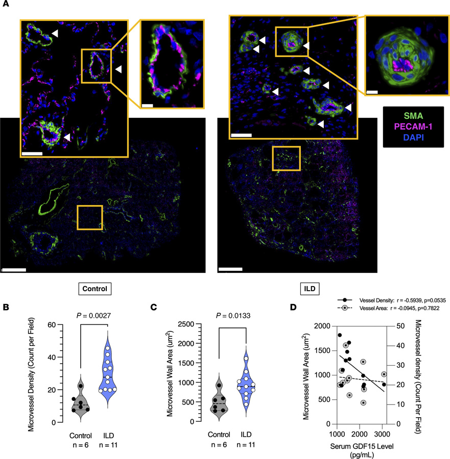 Plasma GDF15 levels correlate with evidence of microvascular change in p...