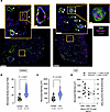 Plasma GDF15 levels correlate with evidence of microvascular change in pati