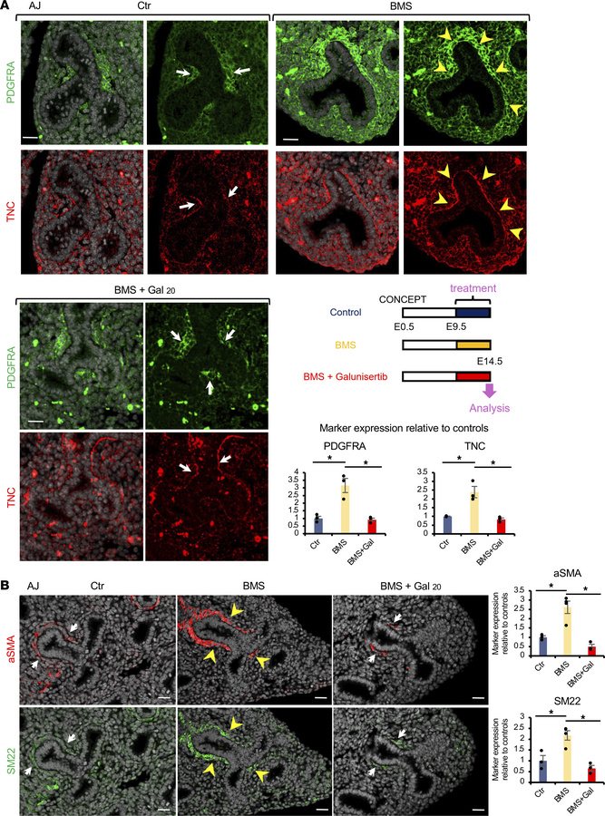 The aberrant airway SM program of prenatal RA signaling disruption in AJ...