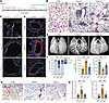 Apelin analog treatment reverses pulmonary vascular remodeling and fibrosis