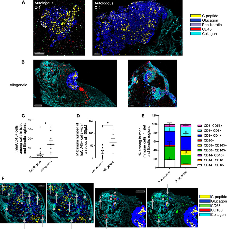 Autologous and allogeneic stem cell–derived islet graft human immune inf...