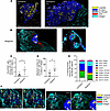 Autologous and allogeneic stem cell–derived islet graft human immune infilt