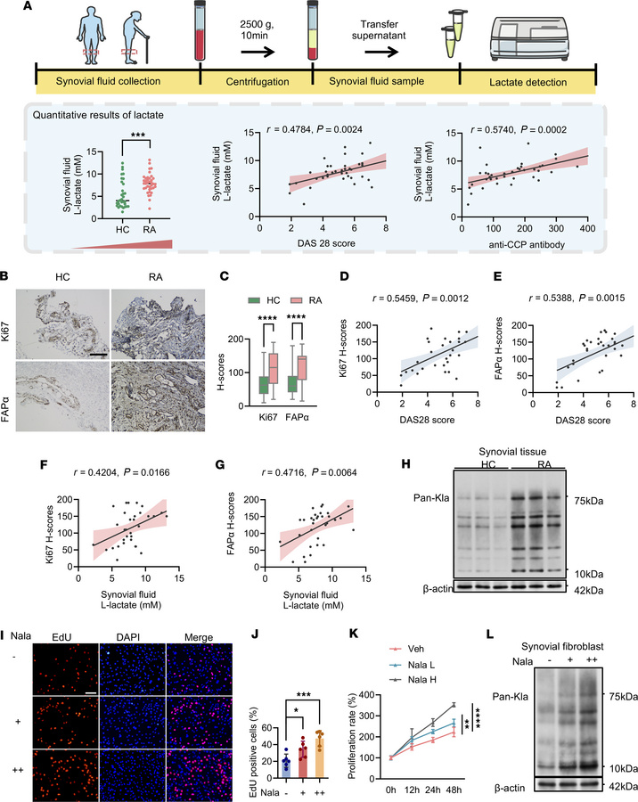Enhanced lactate production and heightened protein lactylation drive syn...