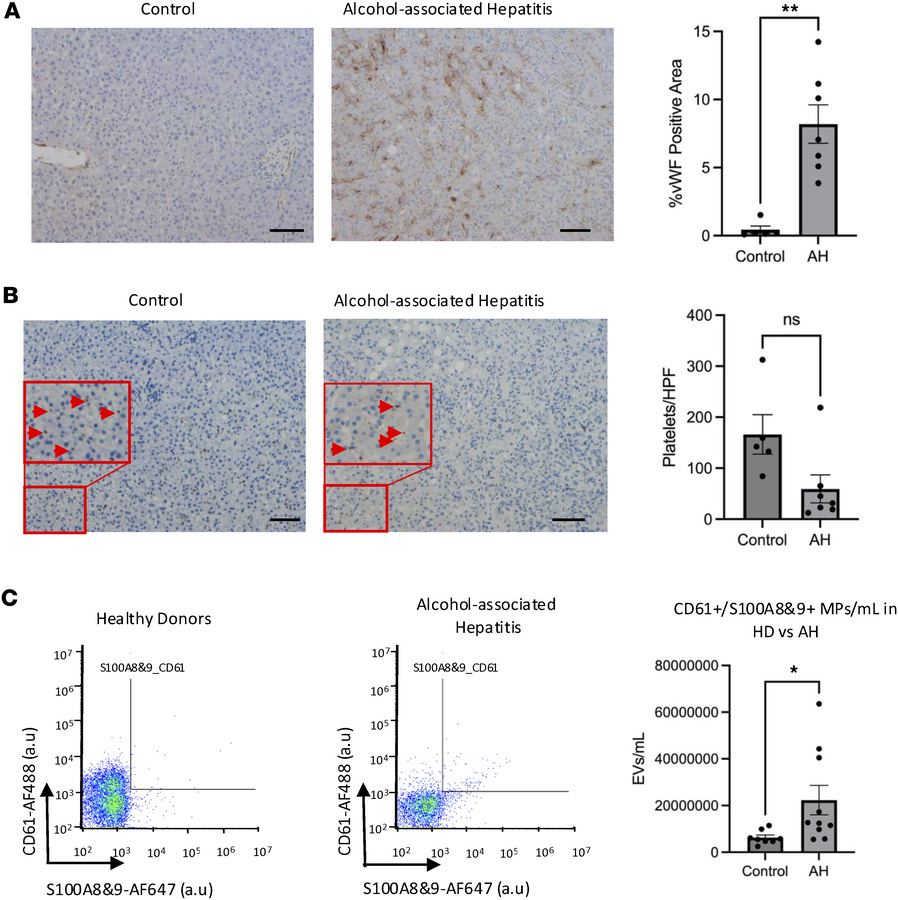 Intrahepatic platelets and circulating platelet-derived microparticles i...