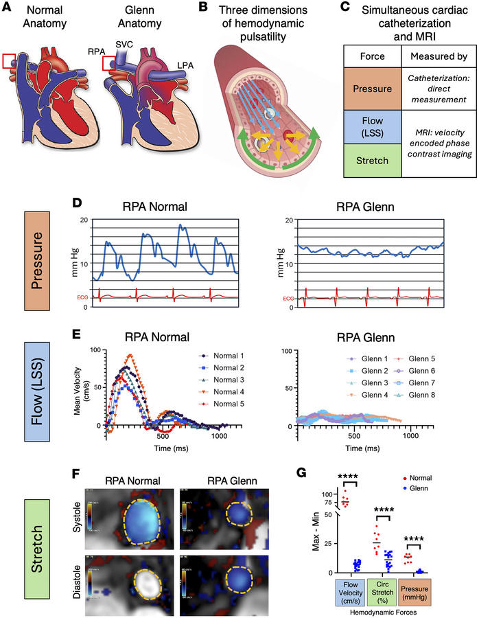 Loss of pulsatility in 3 dimensions within Glenn pulmonary arteries.
(A)...