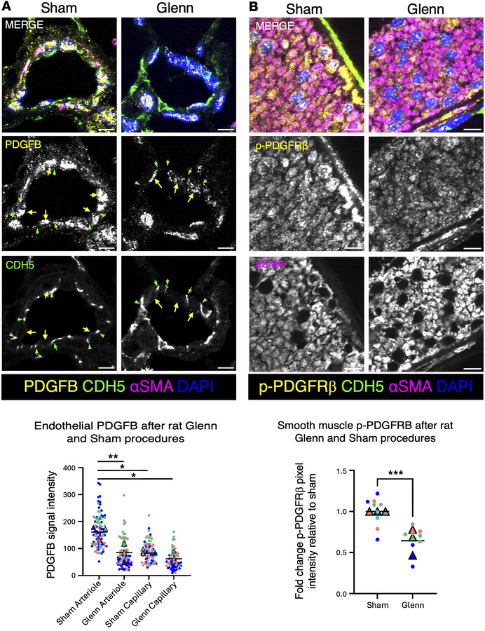 Loss of PDGFB in pulmonary endothelium and p-PDGFRβ in pulmonary vascula...