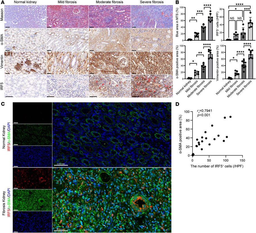 IRF5 was increased in human renal tissues with obstructive nephropathy.
...