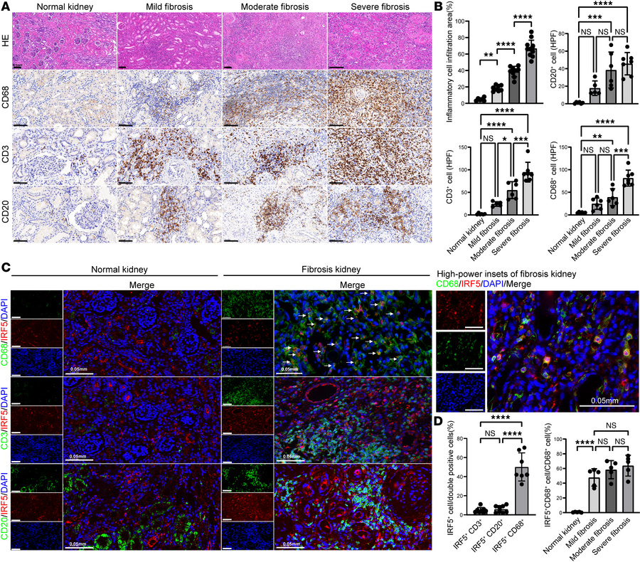 Elevated IRF5+CD68+ cell counts in renal tissues of patients with obstru...