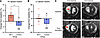 Effects of exenatide in the monocrotaline PAH model.