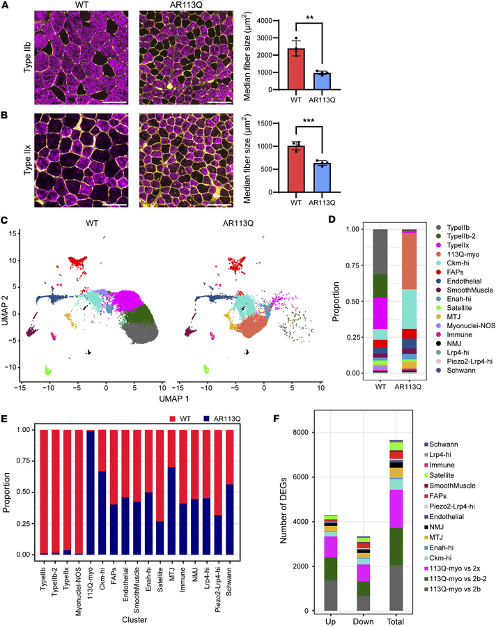 Single-nucleus RNA sequencing reveals a novel, disease-specific populati...