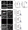 T-tubule maturation deficit in pediatric patients with RVPO.