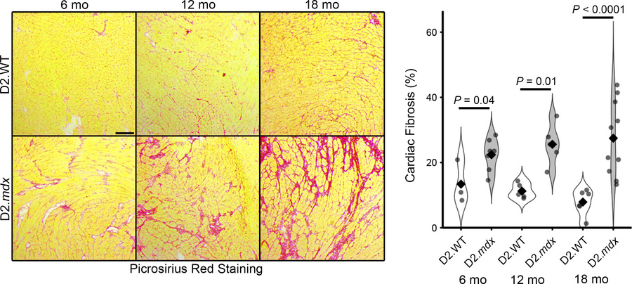 Progressive cardiac fibrosis in D2.mdx mice.
Cardiac fibrosis was visual...