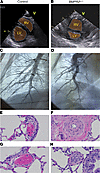 Pulmonary hypertension evaluation.