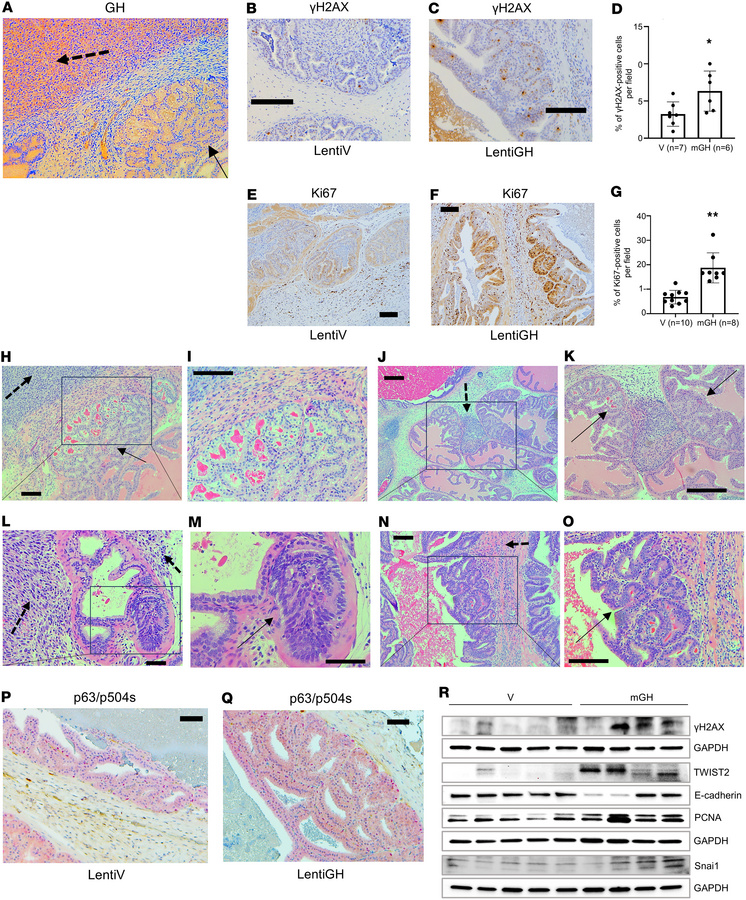 Endocrine/paracrine GH induces changes consistent with BPH.
Murine anter...