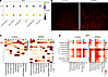 SPP1 expression and signaling are enriched in patients with ADPKD.