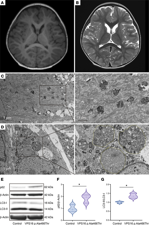 De novo VPS16 missense variant p.Ala466Thr causes caudate atrophy and im...