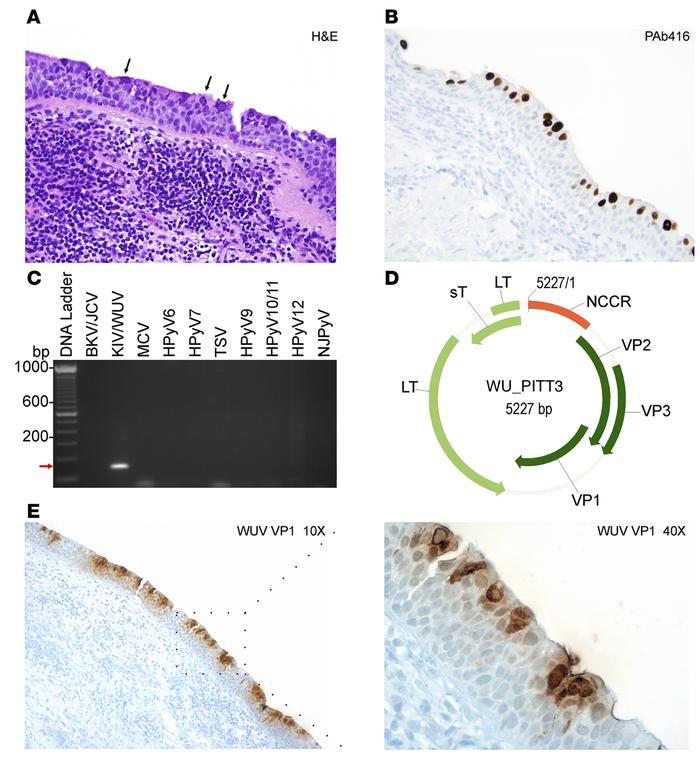 Detection and molecular characterization of WU virus isolated from a chr...